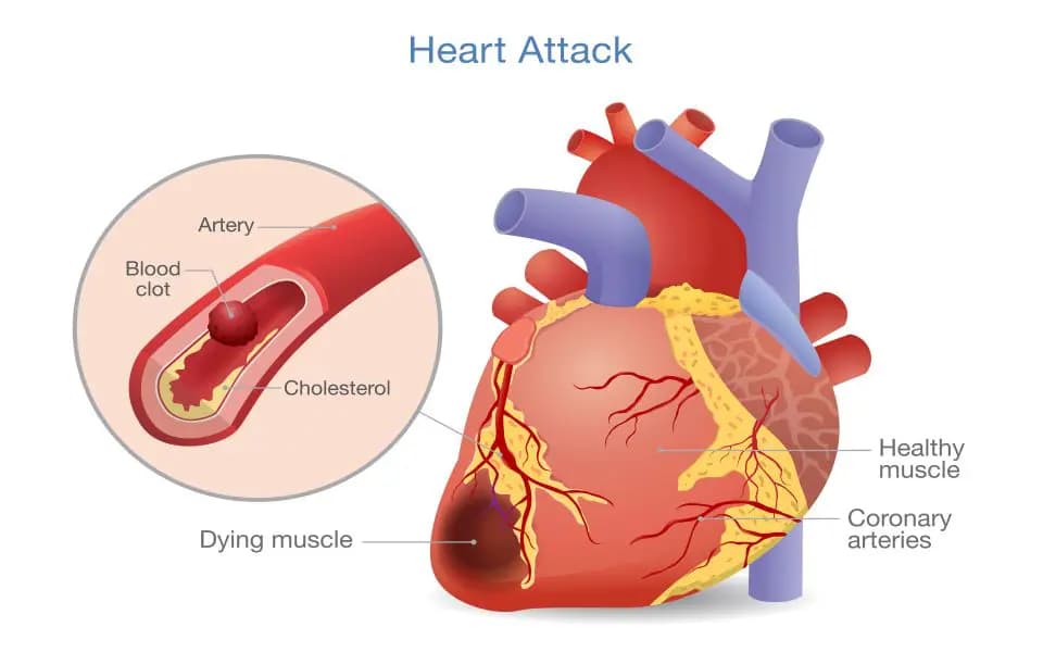 Heart attack illustration of Arterial thrombosis as a blood clot that develops into a heart attack