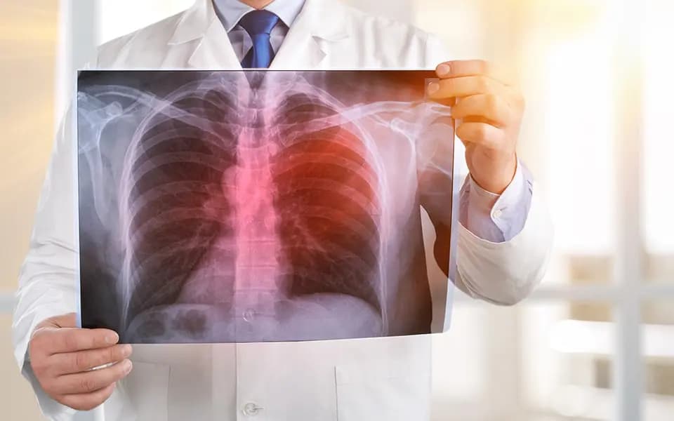 X-ray of lungs