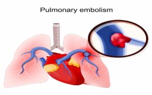 Pulmonary embolism diagram showing a blood clot in the lungs